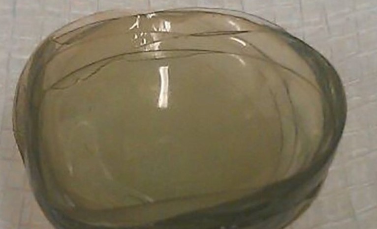 Surgeons Remove 27 Contact Lenses From Woman’s Eye